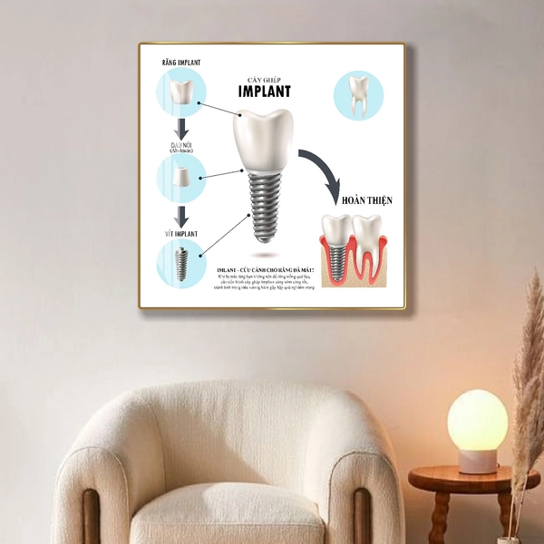 Tranh Treo Tường Nha Khoa Cấy Ghép IMPLANT