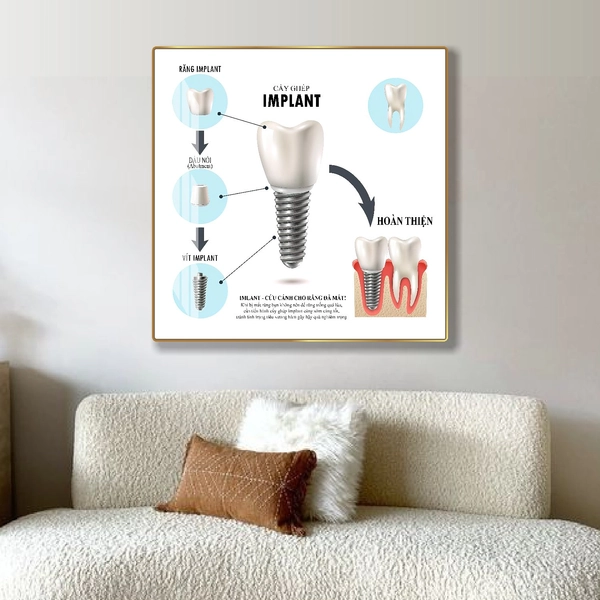 Tranh Treo Tường Nha Khoa Cấy Ghép IMPLANT