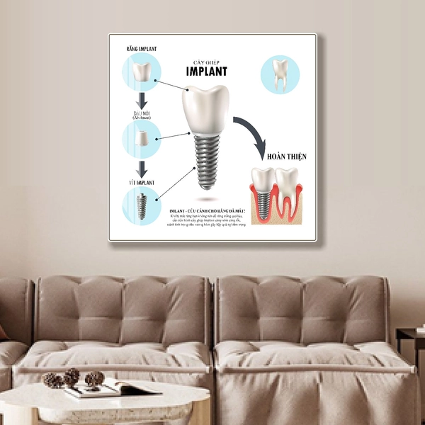 Tranh Treo Tường Nha Khoa Cấy Ghép IMPLANT